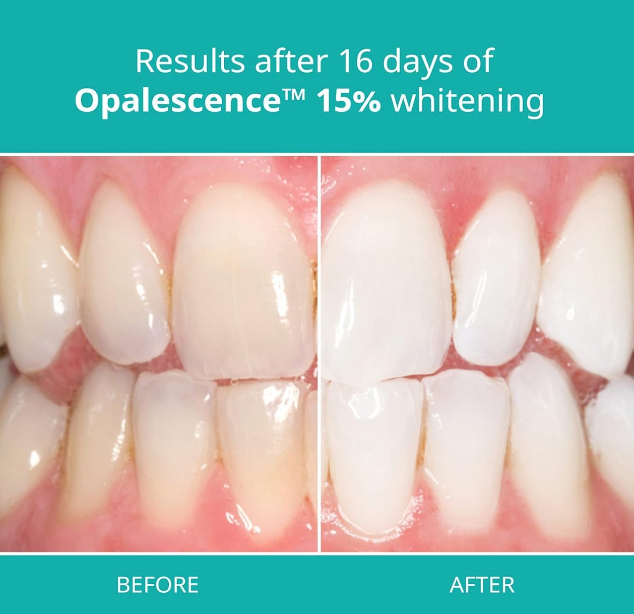 Teeth Whitening Gel 15% HP | 4 Pack | Made in USA - Snap Custom Nightguards